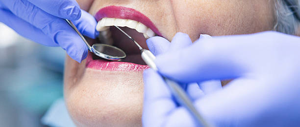 Best Chipped Tooth Repair Near Me  in Rancho Santa Margarita, CA